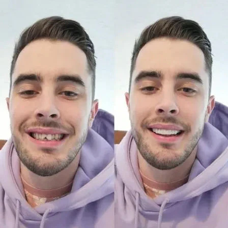 On Smile Veneers Upper and Lower Teeth Set