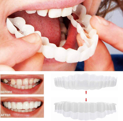 On Smile Veneers Upper and Lower Teeth Set