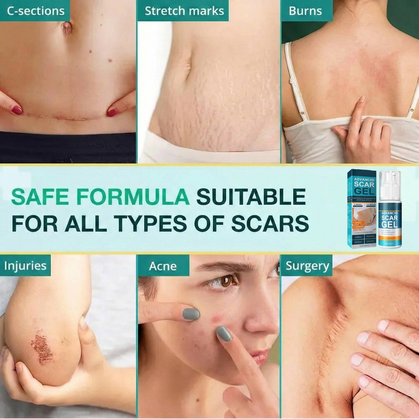 Silicone Scar Gel Moisturizing Cream for Skin Marks and Stretch Marks