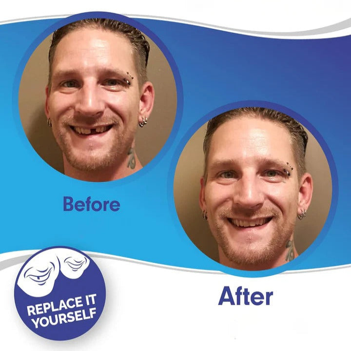 Clip On Teeth Veneer Set for Upper and Lower Coverage