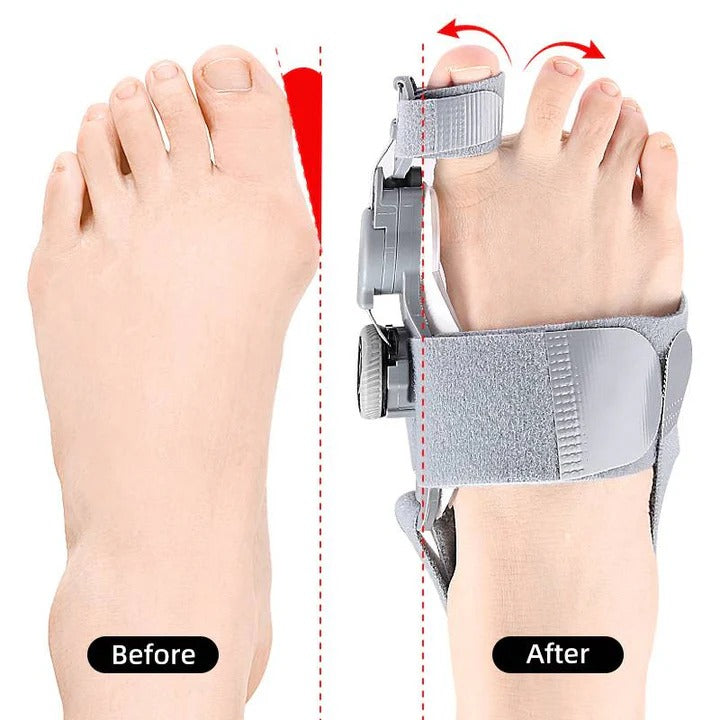 Toe Alignment Support Device with Adjustable Knob Design