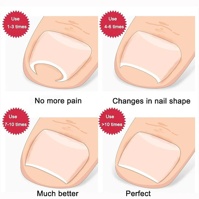 2 Piece Toenail Correction Clip Set with Stainless Steel Straightening Tool for Nail Care