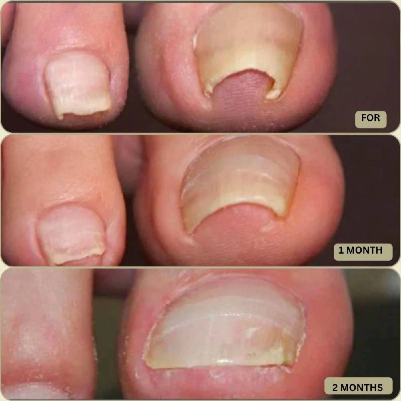Instant Nail Repair Corrector for Ingrown and Damaged Nails