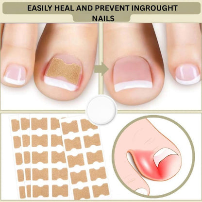 Instant Nail Repair Corrector for Ingrown and Damaged Nails